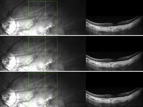 Lacquer Cracks And Perforating Scleral Vessels In Pathologic Myopia A