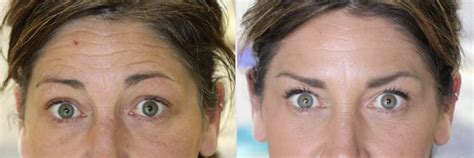 How much did i have? Botox Before And After Fillers Under Eyes : Botox Under ...