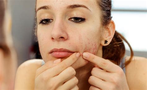 These 10 Tips Will Help To Remove Whiteheads From Face Daily News