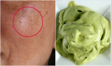 Ways To Reduce Discolored Patches On Face Makeupandbeauty Com