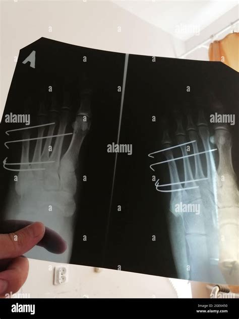 Orthopedic Surgery Of Human Foot On X Ray Pin Osteosynthesis Stock
