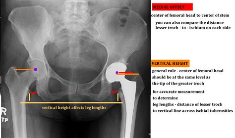 Stem Placement — Hip And Knee Book