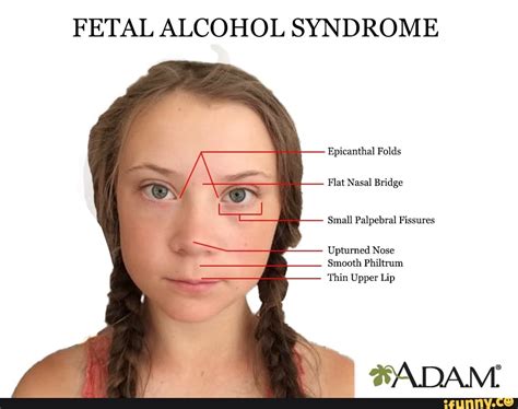 The epicanthic fold produces the eye shape characteristic of persons from central and eastern asia; FETAL ALCOHOL SYNDROME Epicanthal Folds Flat Nasal Bridge Small Palpebral Fissures Upturned Nose ...