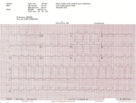 Unstable Bradycardia Resolves Following Atropine And Attempted