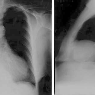 Radiografias Do T Rax Em P Stero Anterior A E Perfil B Mostrando