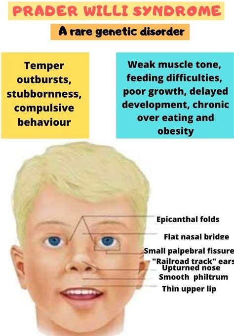 Prader Willi Syndrome Symptoms