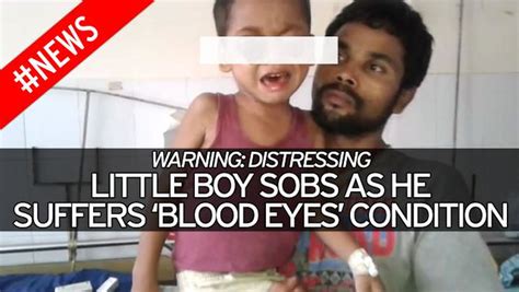 Little Boy Who Cried Blood Because Of Horrifying Eye Bulging Condition