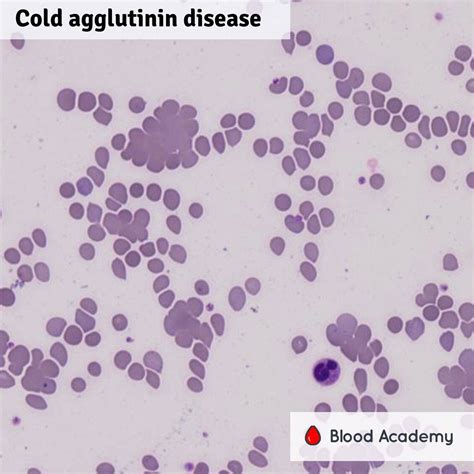 Cold Agglutinin Disease Blood Academy