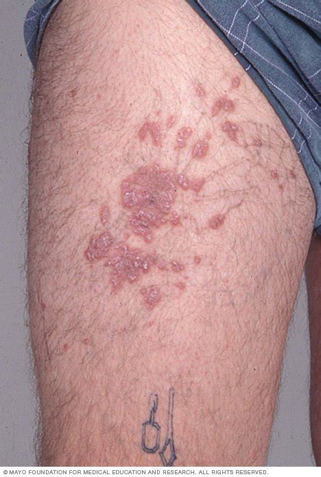 Feb 09, 2012 · this month's clinical infectious diseases evaluated the transmission of hcv through tattooing and piercing. Tattoos: Understand risks and precautions - Drugs.com