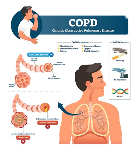 Copd Never Take A Single Breath For Granted St Clair Health Blog