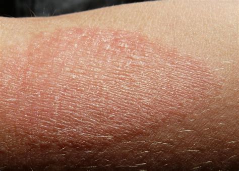 Dry Skin Patches Causes Symptoms Diagnosis And Treatments Dry