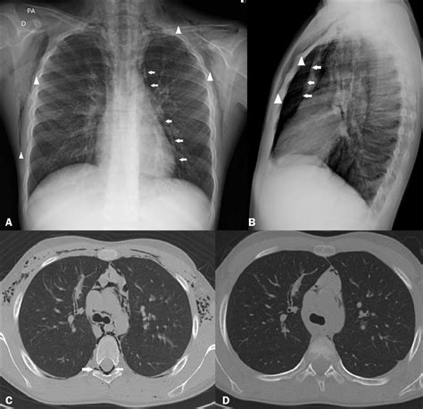 Chest X Rays In Posteroanterior And Lateral Views A And B