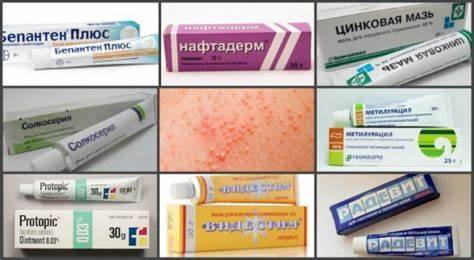 Аллергический дерматит какая диета Виды Дерматитов Фото С Названиями — Картинки фотографии Виды Дерматитов Фото С Названиями — Картинки фотографии Аллергический дерматит какая диета