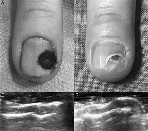 Ultrasound Guided Minimally Invasive Resection Of A Digital Glomus