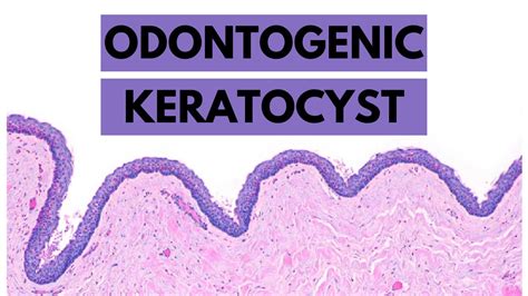 Odontogenic Keratocyst Clinical Features Radiology Histology And