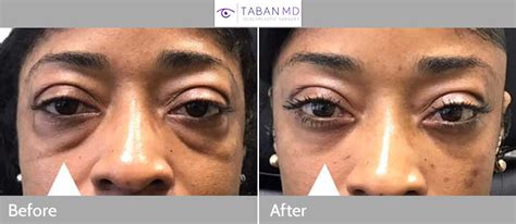 Lower Blepharoplasty Before And After Gallery Taban Md
