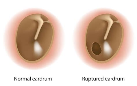 Tympanic Membrane Perforation So You Have A Ruptured Ear Drum Now What Michigan Ent