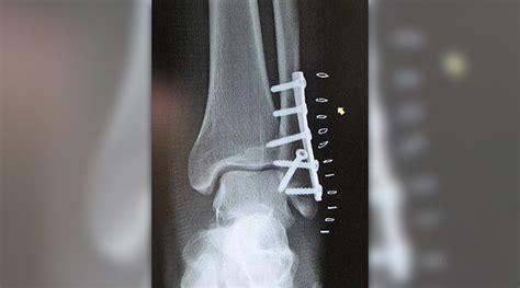 Spiral Fracture Of Tibia And Fibula Recovery Time Updateslomi