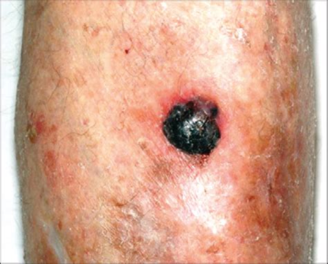 Cutaneous Blood Filled Vesicles On Idraparinux The Lancet