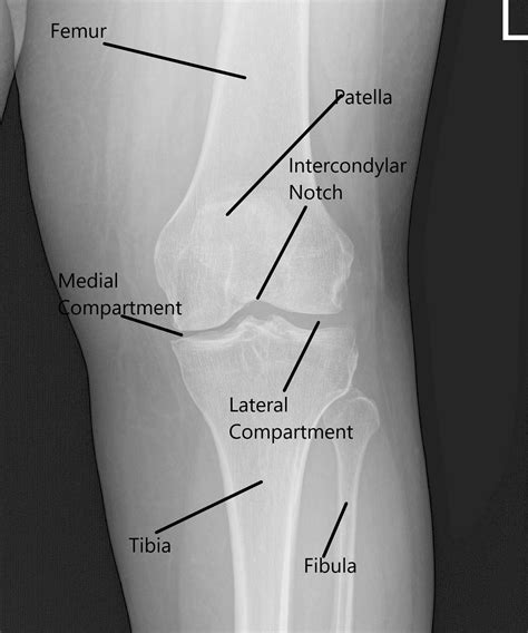 Case Study Endobutton And Chondroplasty Of Left Knee