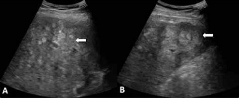 A B Sonographic Images Show Multiple Hyperechoic Nodules In Both
