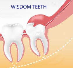 Do you know who did your extraction? Wisdom teeth/Minor oral surgery - Bella Vista Family ...