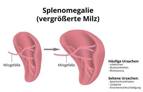 Splenomegalie