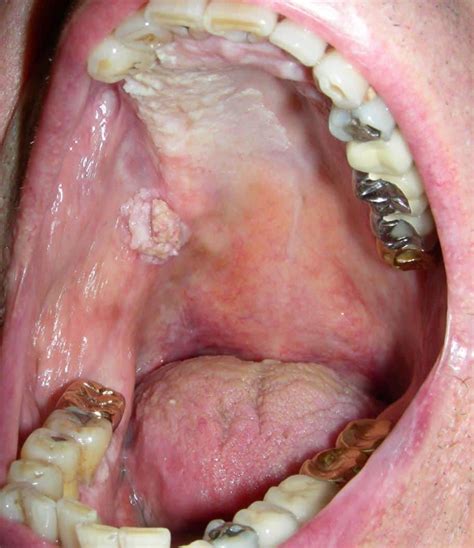 Early Stage White Spots Throat Cancer