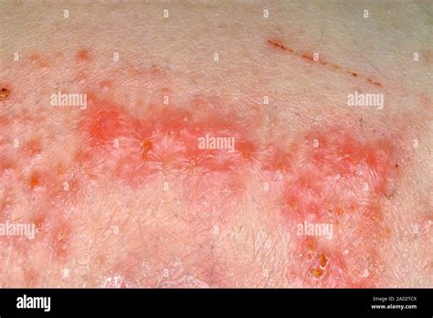 Allergic Reaction To Dressing Adhesive Close Up A Rash On The Back Of
