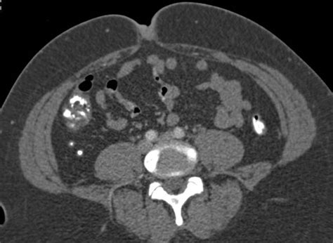 Retrocecal Appendix Colon Case Studies Ctisus Ct Scanning