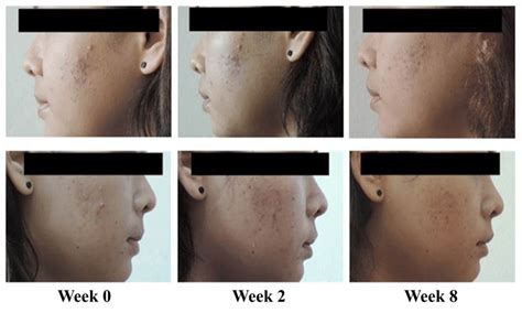 Case Study A 21 Year Old Female With Moderate Severity Acne Vulgaris