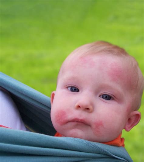 4 Causes Of Ringworm In Babies Symptoms And Treatment
