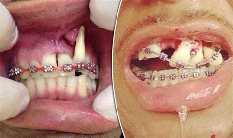 Trend For Diy Braces Leads To Irreversible Dental Damage Uk