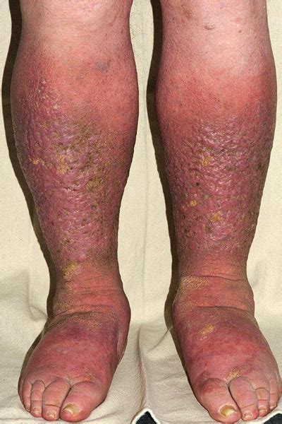 Have You Got Cellulitis Or Red Legs Lymphoedema Support Network Lsn