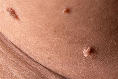 Hpv Warts Skin Tags Private Parts Waterryte