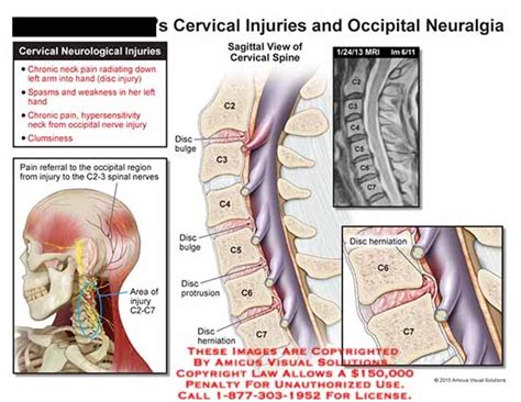 Amicus Illustration Of Amicus Injury Cervical Neurological Chronic Pain Neck Spasms Weakness