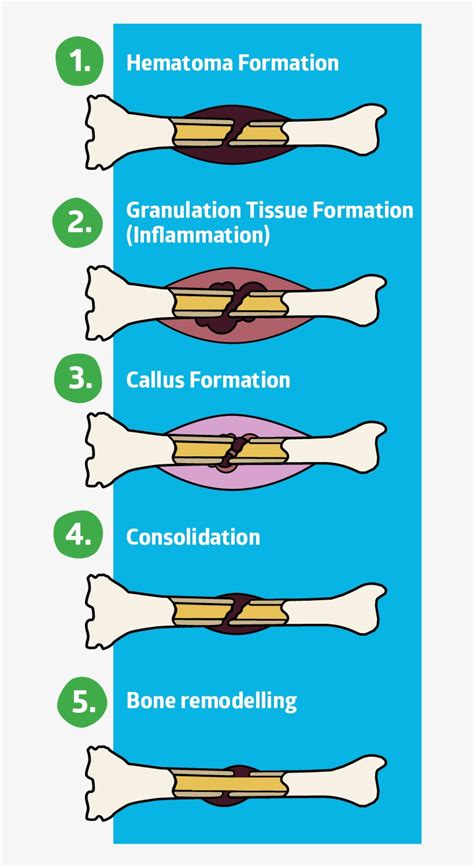 Hematoma Formation Fracture Healing Stages Transparent Png 666x1420