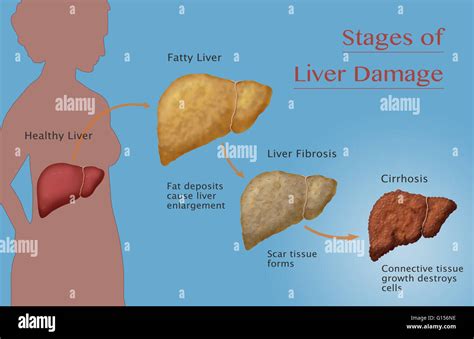 Liver Fibrosis High Resolution Stock Photography And Images Alamy