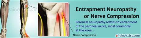 Entrapment Neuropathy Treatment Symptoms Causes Types