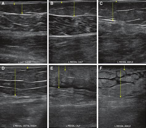Ultrasonography Comparison Of Lipedema A C And Lymphedema D F At