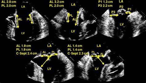 Mitral Valve Repair: An Echocardiographic Review: Part 1 - Journal of