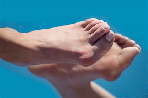 Bunions Hammertoes And Crooked Toes Are Serious And Often Need
