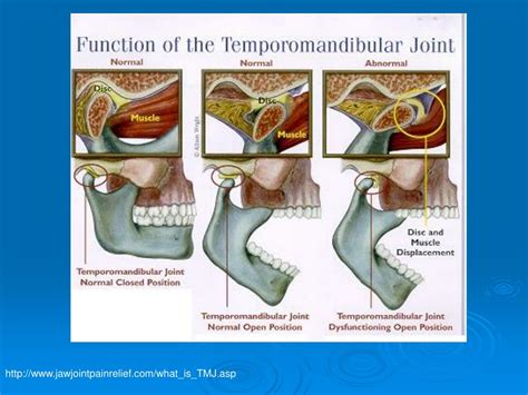 Ppt Engineering A Tmj Disc Powerpoint Presentation Free Download