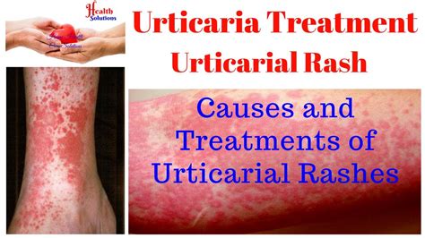 Urticaria Causes And Treatment