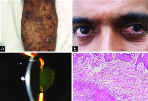 A Multiple Hyperpigmented To Skin Colored Papules And Nodules Present