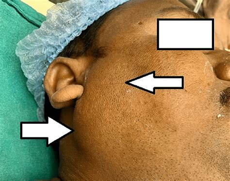 Swollen Parotid Gland On One Side