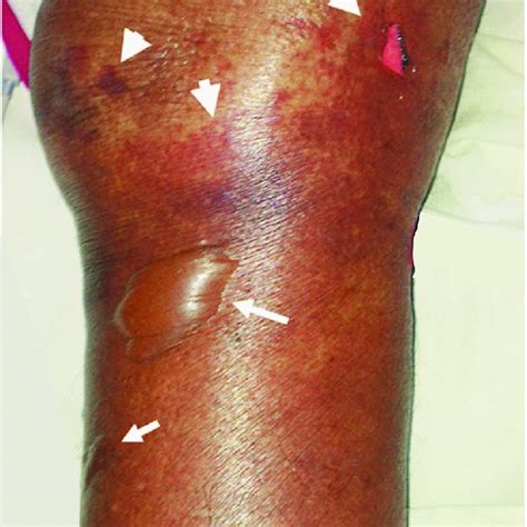 Fig Photograph Showing Non Blanchable Purple Coloured Skin Lesions