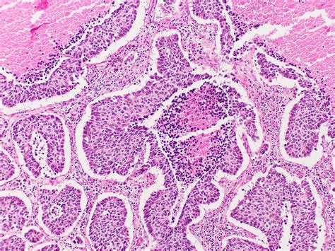 Large Cell Neuroendocrine Carcinoma Nature Inspiration Cell Pattern