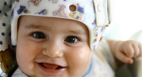 Plagiocephaly Flat Head Syndrome Babycenter