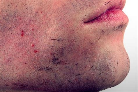 Ingrown Facial Hair Cyst Bump Deep Infection Causes